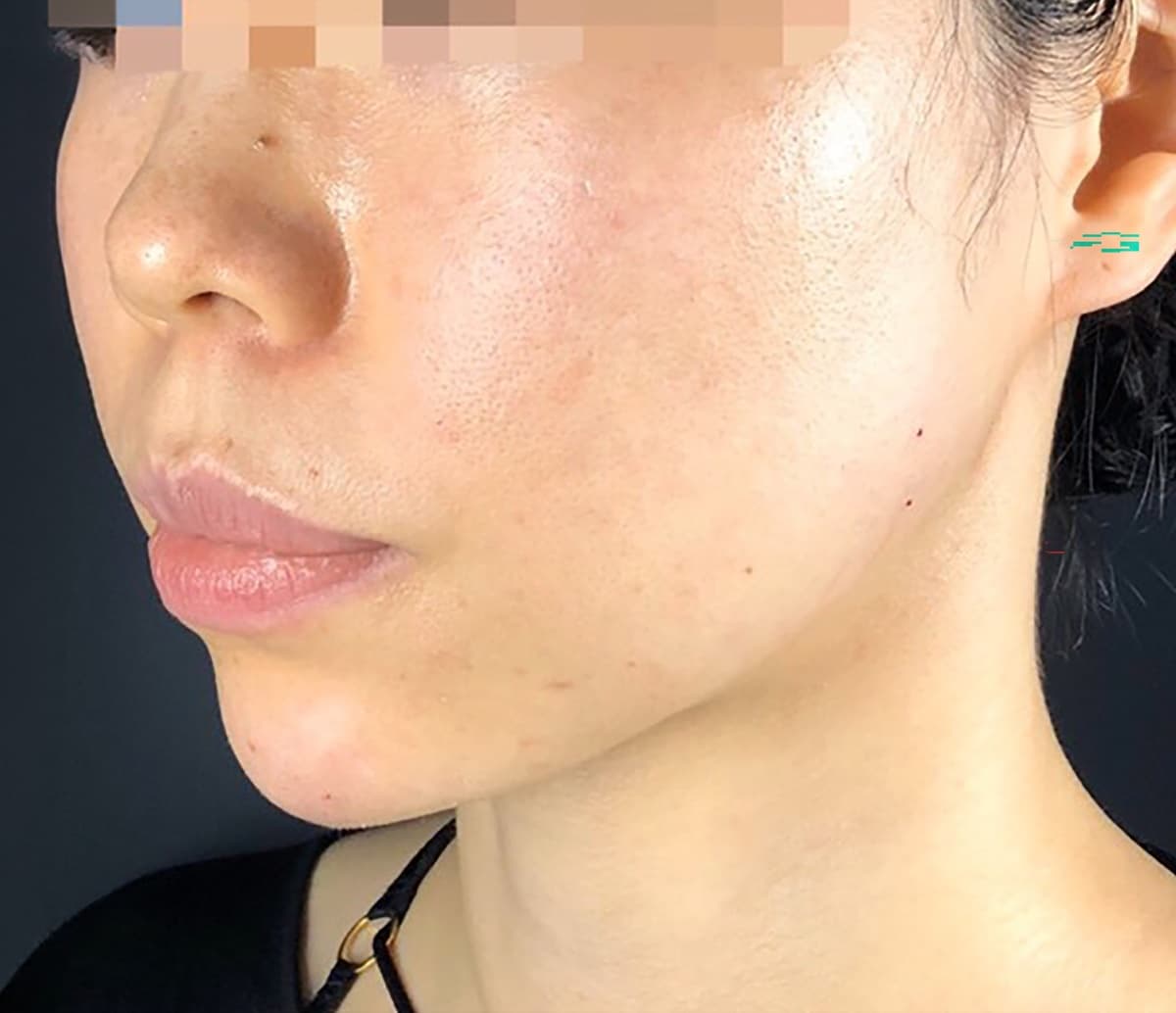 Hyaluronic Acid E-Line Lift After