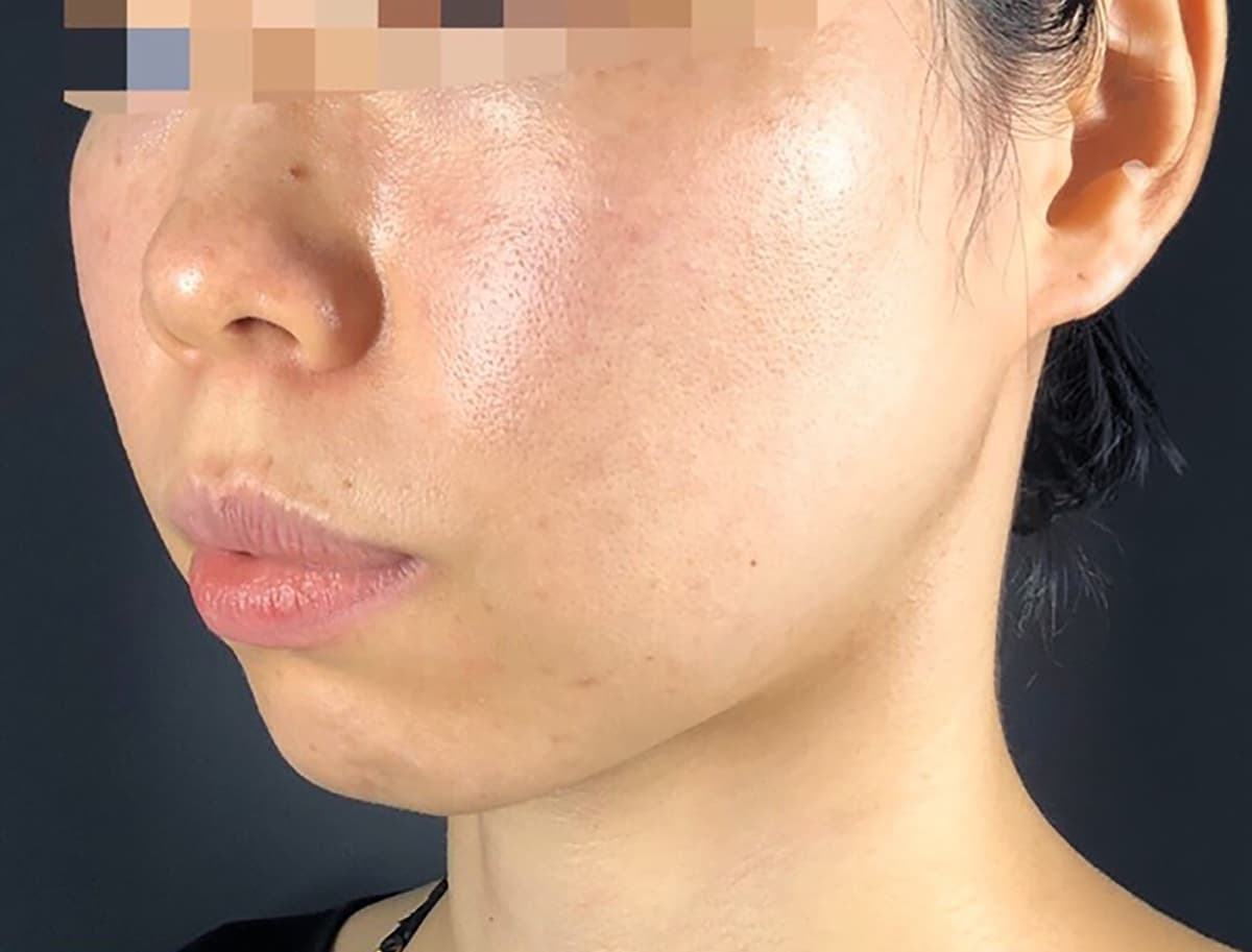Hyaluronic Acid E-Line Lift Before