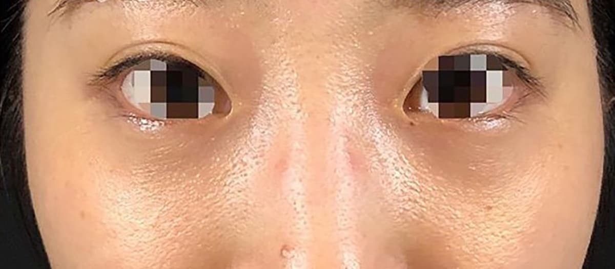 Lower Eyelid Fat Removal Surgery After