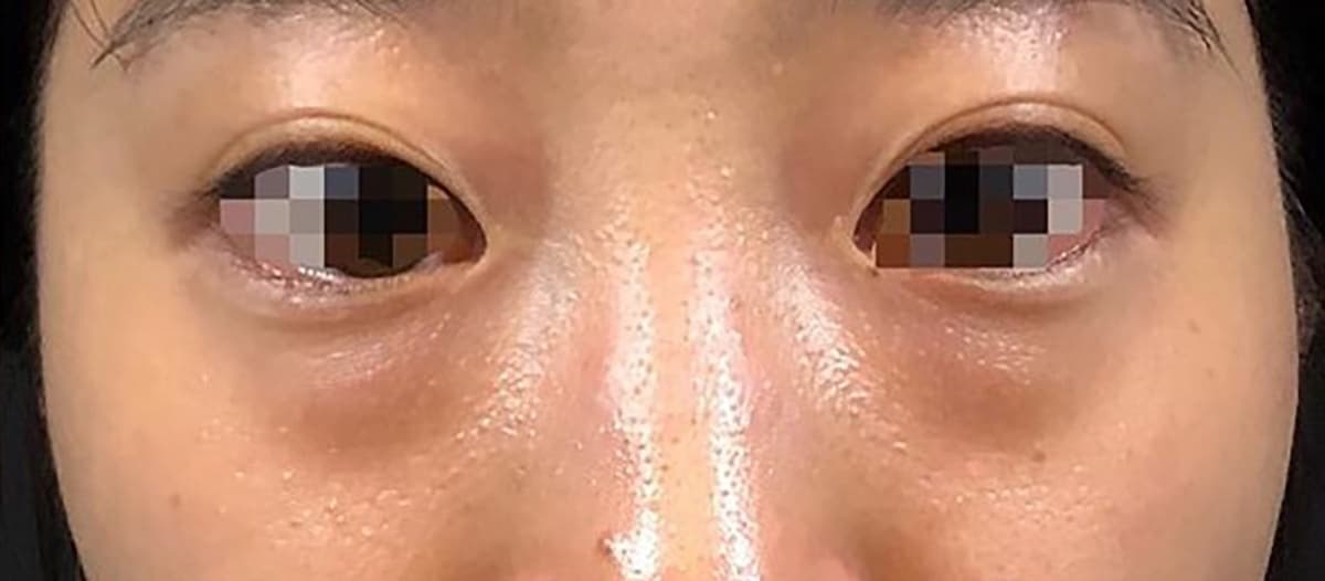 Lower Eyelid Fat Removal Surgery Before