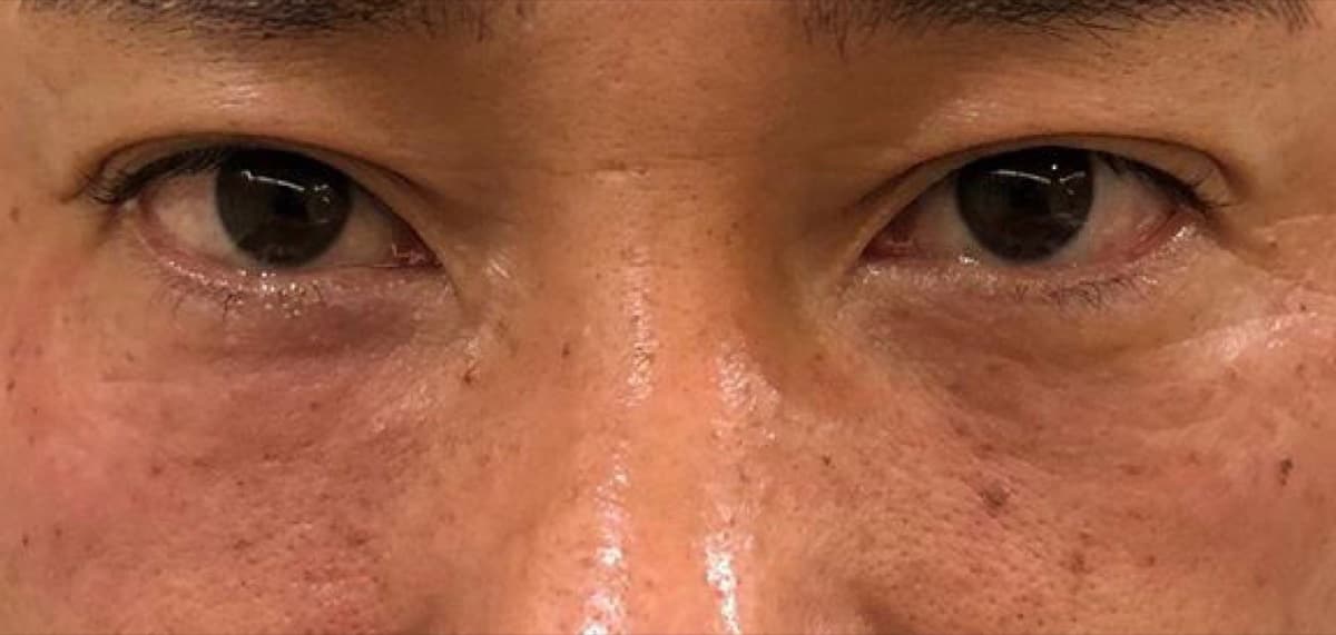 Under-Eye Baby Collagen Injection After