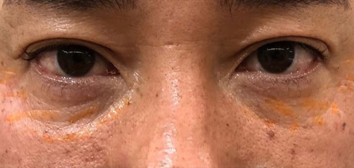 Under-Eye Baby Collagen Injection Before