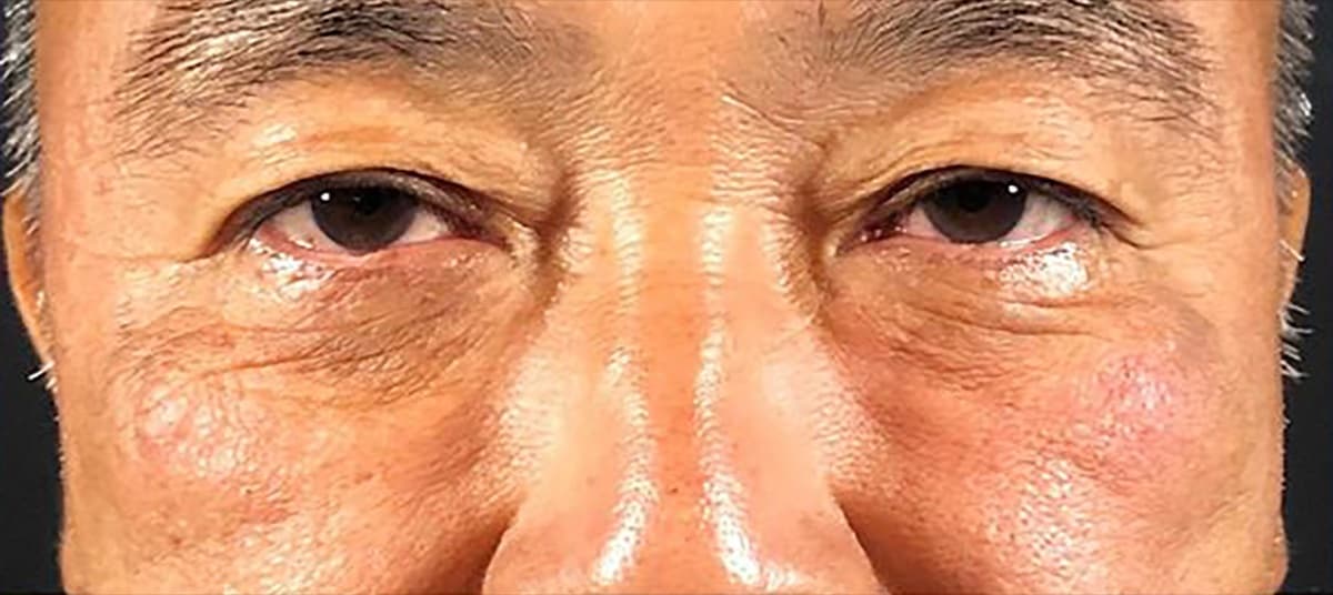 Lower Eyelid Fat Removal Surgery After