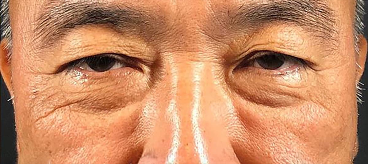 Lower Eyelid Fat Removal Surgery Before