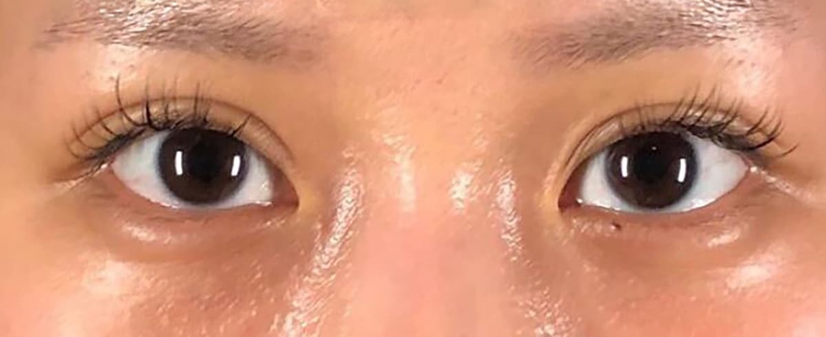 Rejuva Eyes Double (Eyelid) After