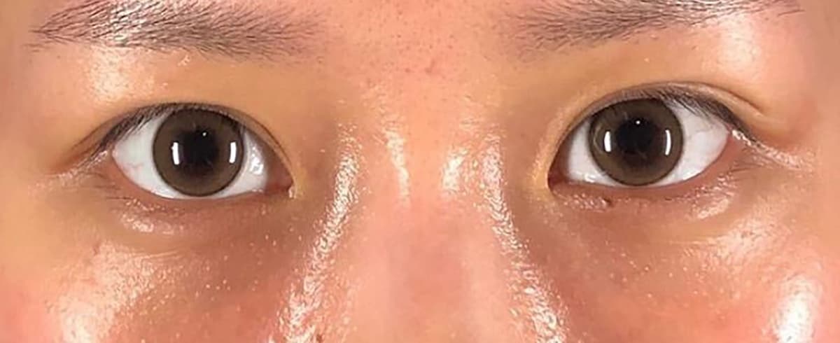 Rejuva Eyes Double (Eyelid) Before