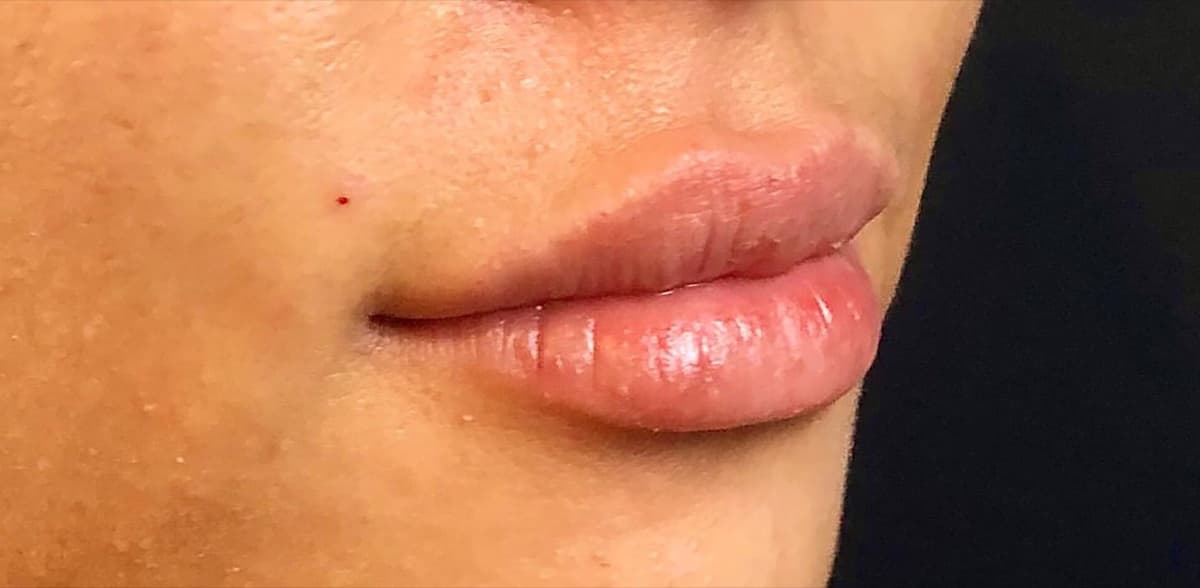 Philtrum Shortening Hyaluronic Acid Injection After