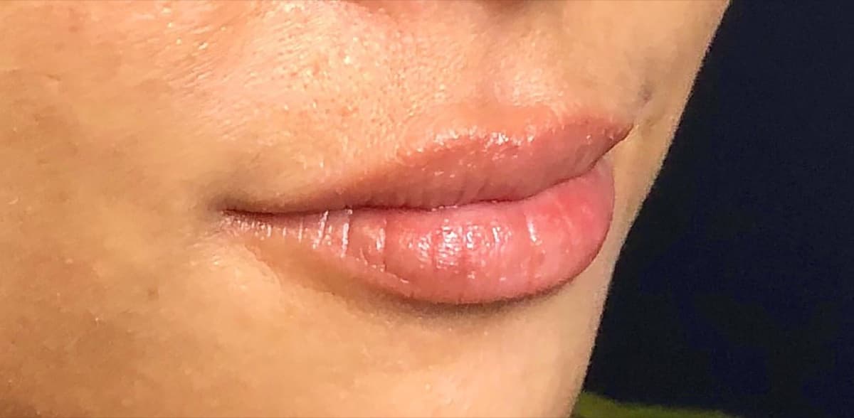 Philtrum Shortening Hyaluronic Acid Injection Before