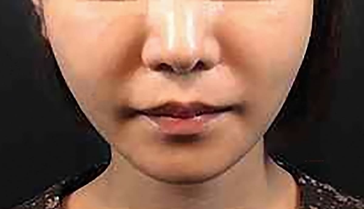 Combination Lift (HIFU + Thread) After