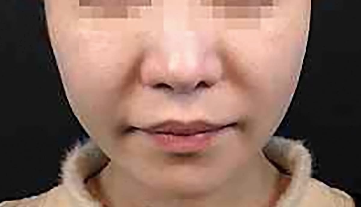 Combination Lift (HIFU + Thread) Before
