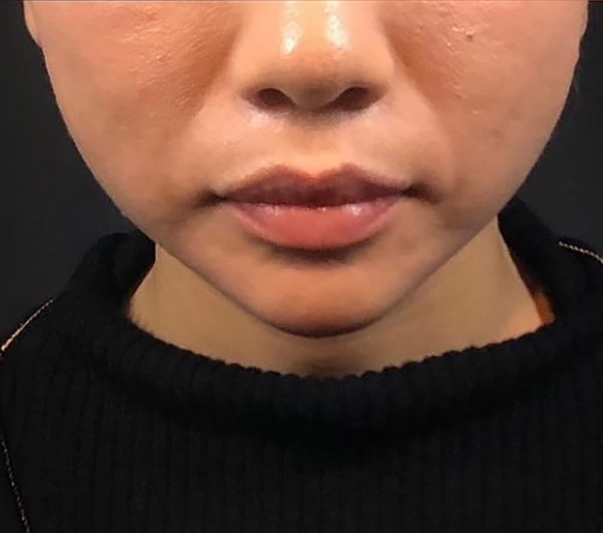Jawline Contouring After