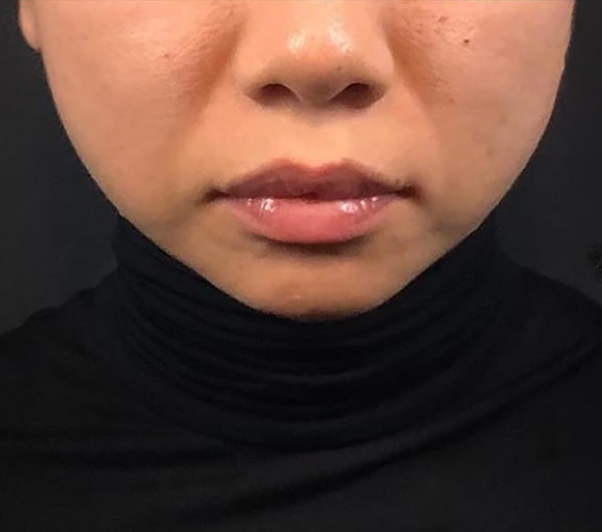 Jawline Contouring Before