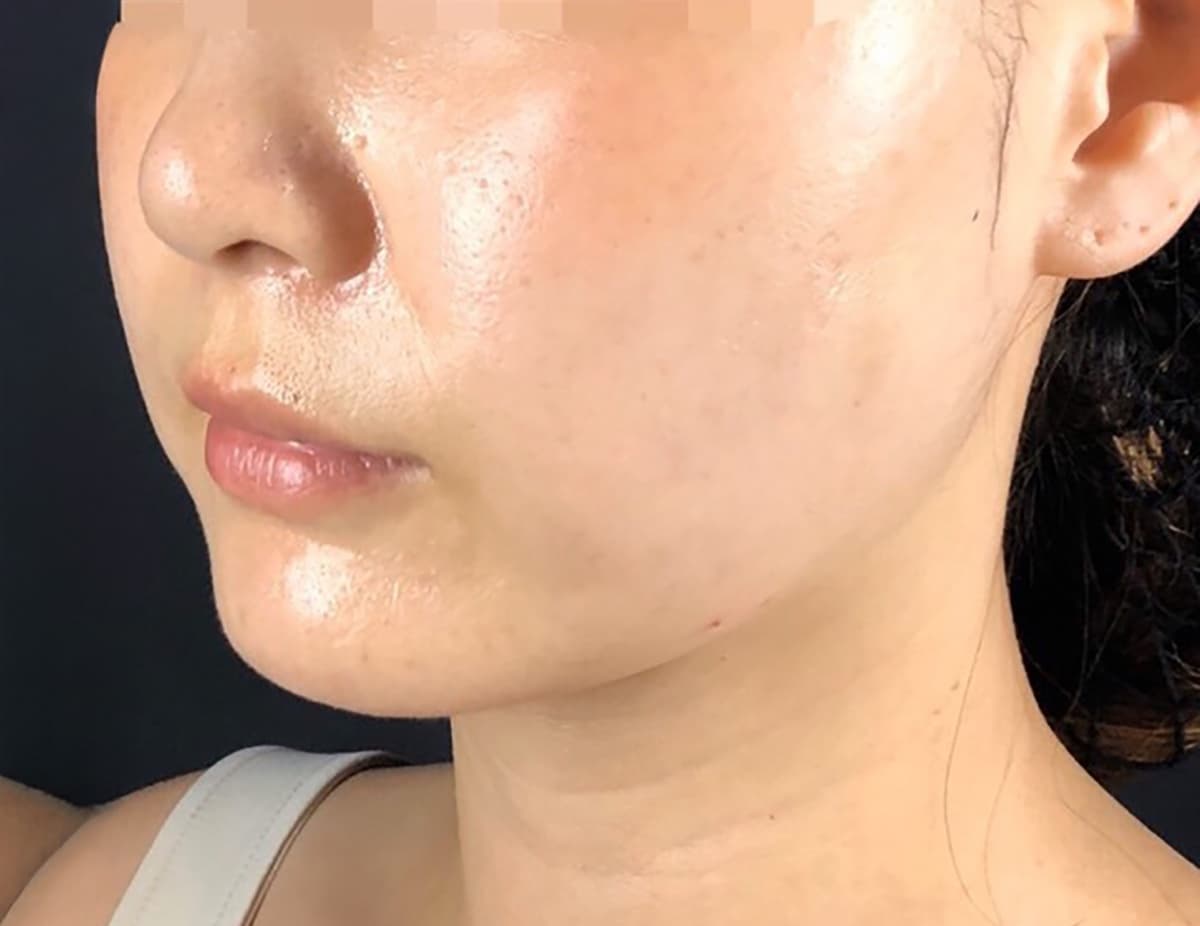 Combination Lift (HIFU + Thread) After