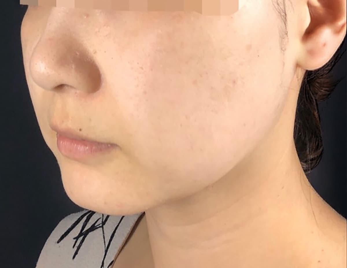 Combination Lift (HIFU + Thread) Before
