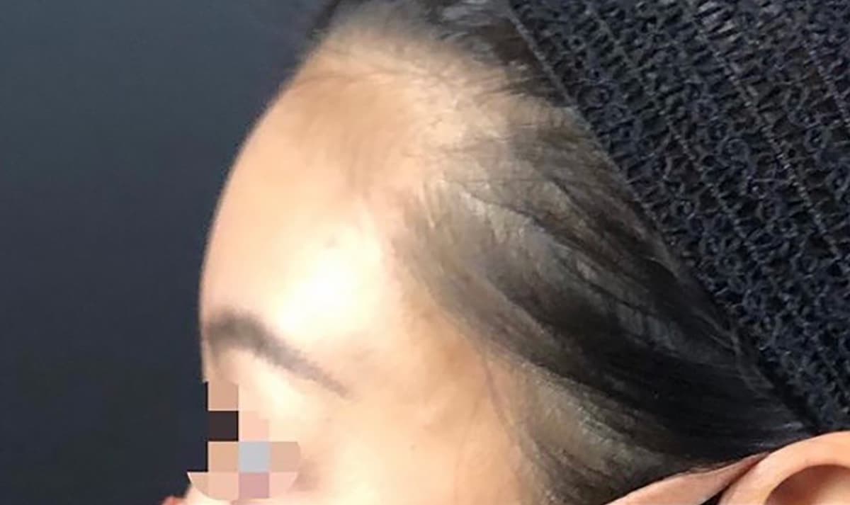 Forehead Hyaluronic Acid After