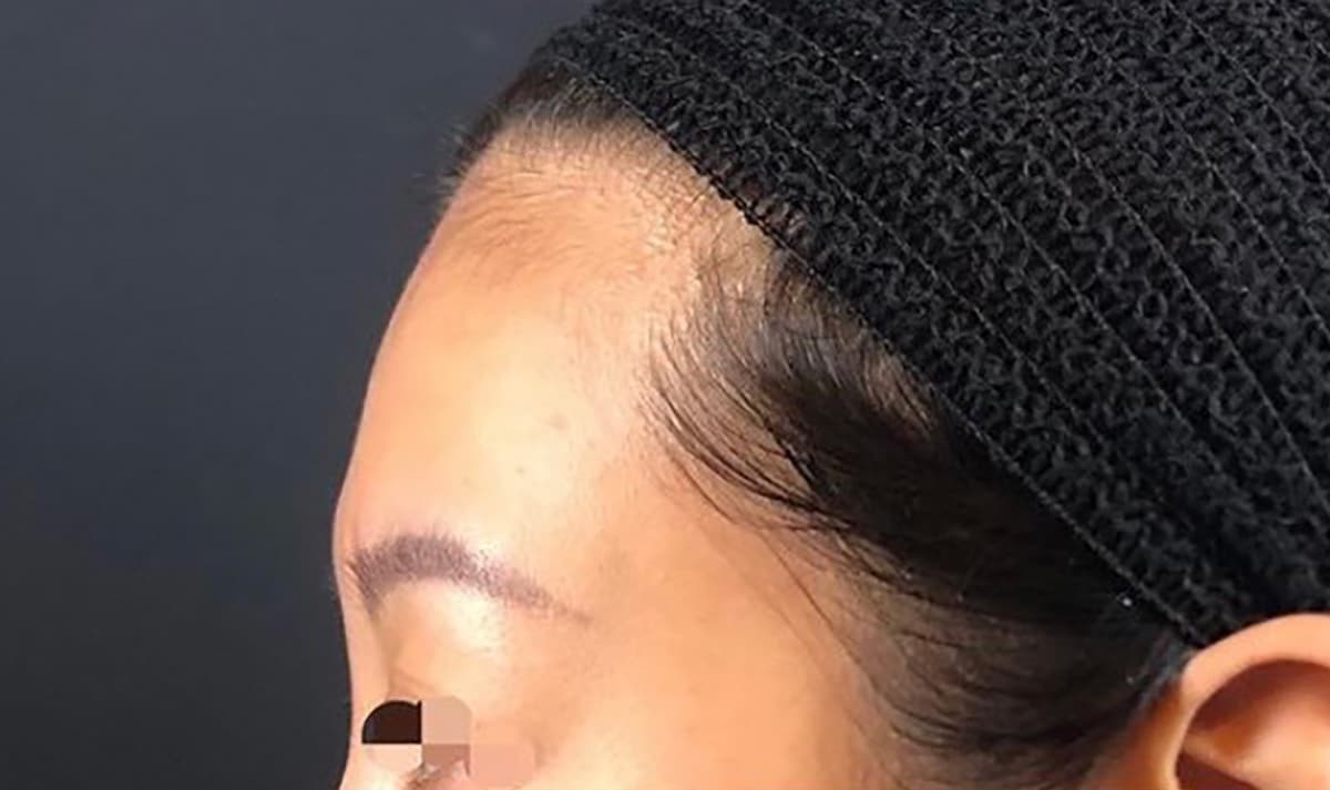 Forehead Hyaluronic Acid Before