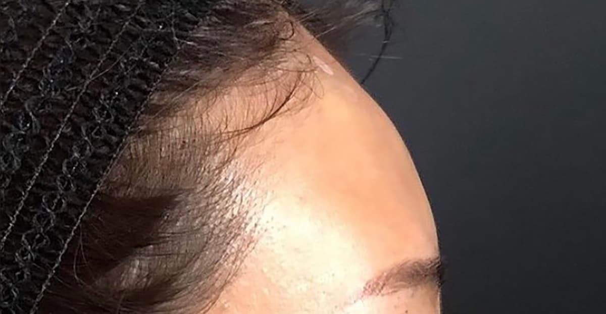 Forehead Hyaluronic Acid After