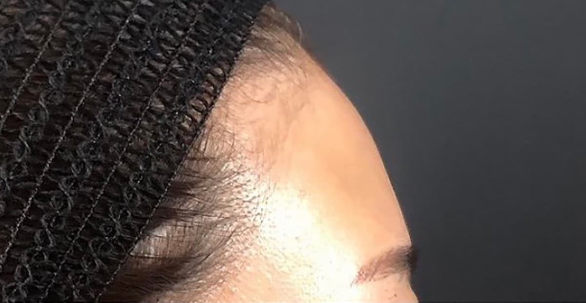 Forehead Hyaluronic Acid Before