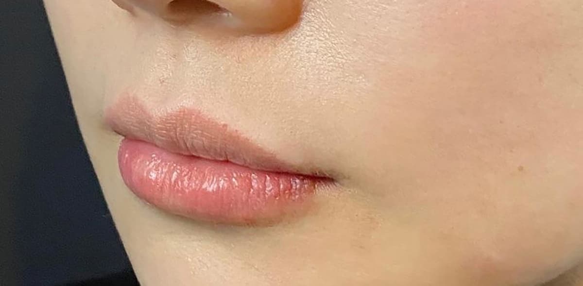 Philtrum Shortening (Botox + Filler) After