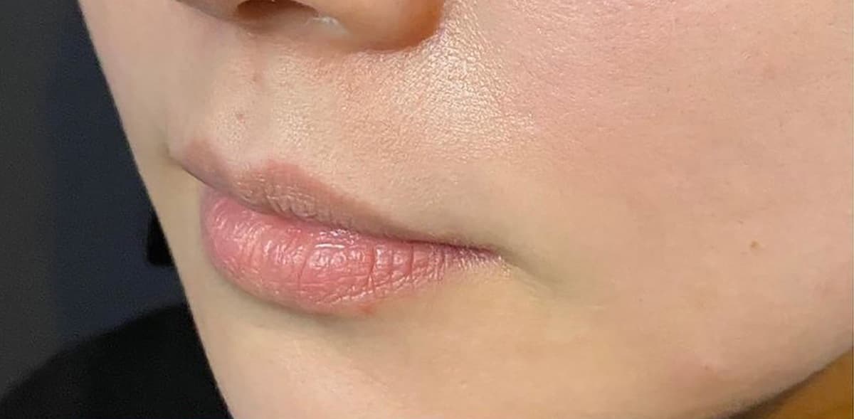 Philtrum Shortening (Botox + Filler) Before