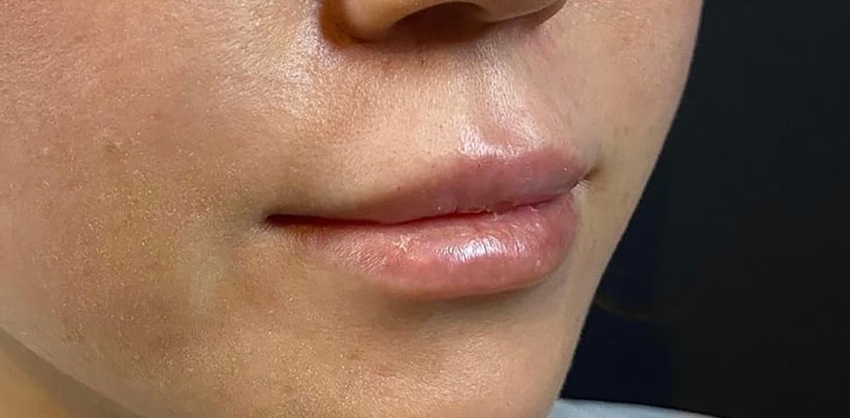 Philtrum Shortening (Botox + Filler) After