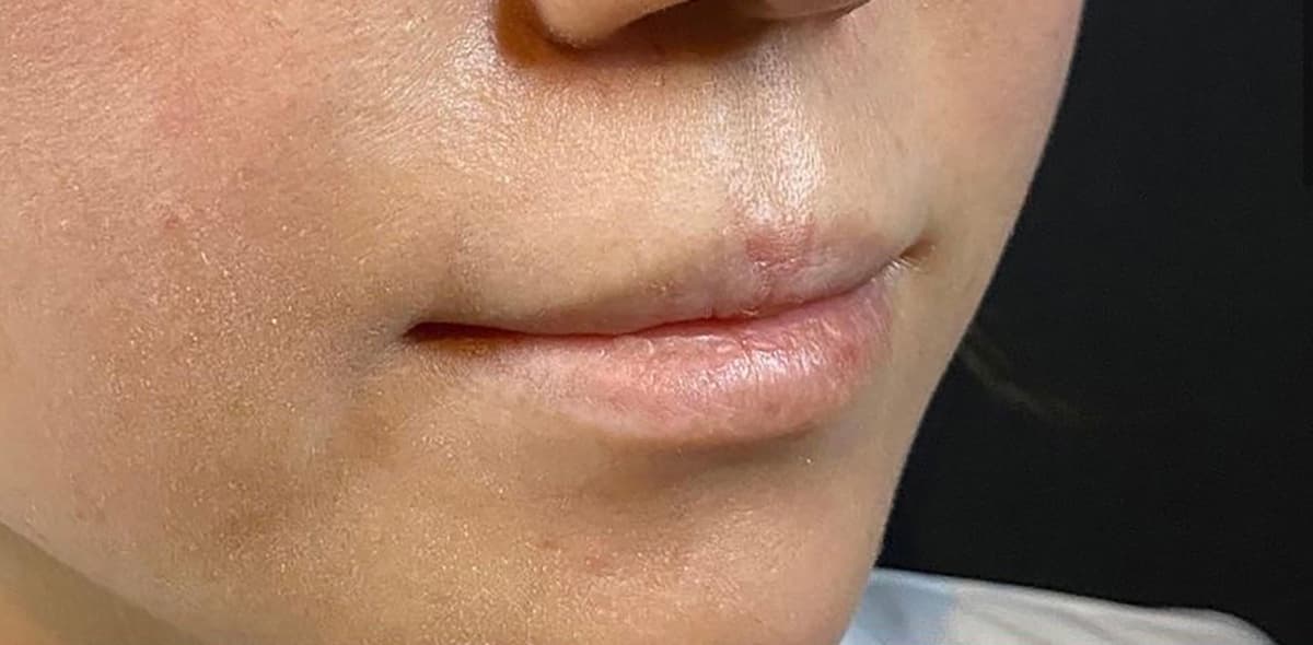 Philtrum Shortening (Botox + Filler) Before