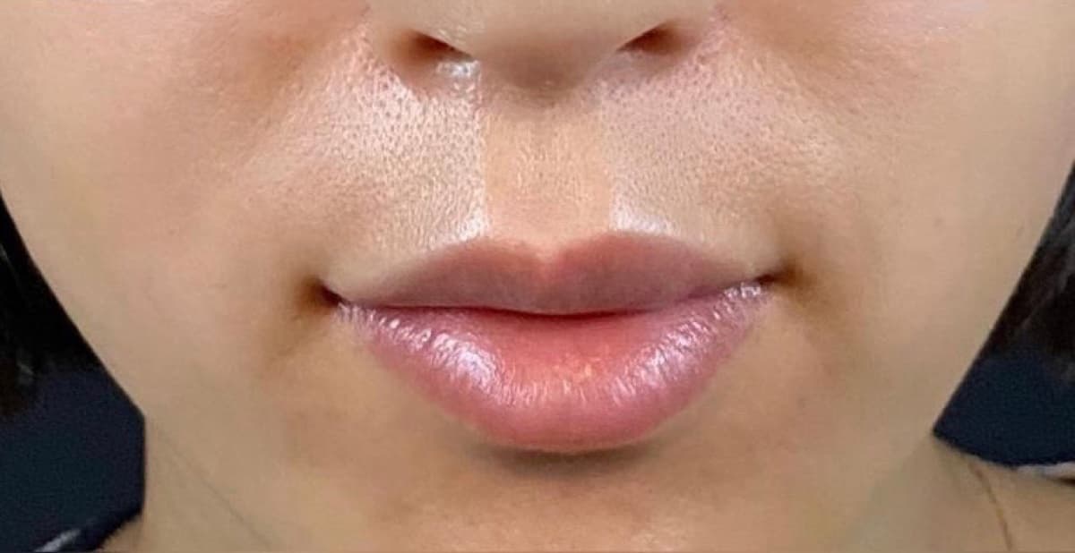 Philtrum Shortening (Botox + Filler) After