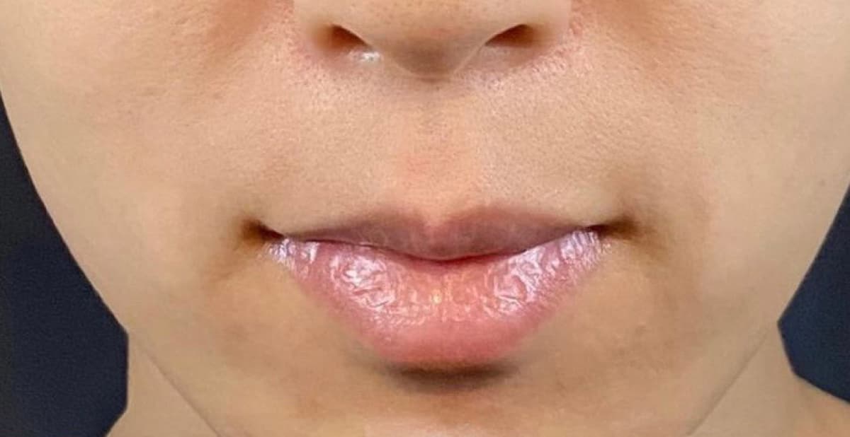 Philtrum Shortening (Botox + Filler) Before