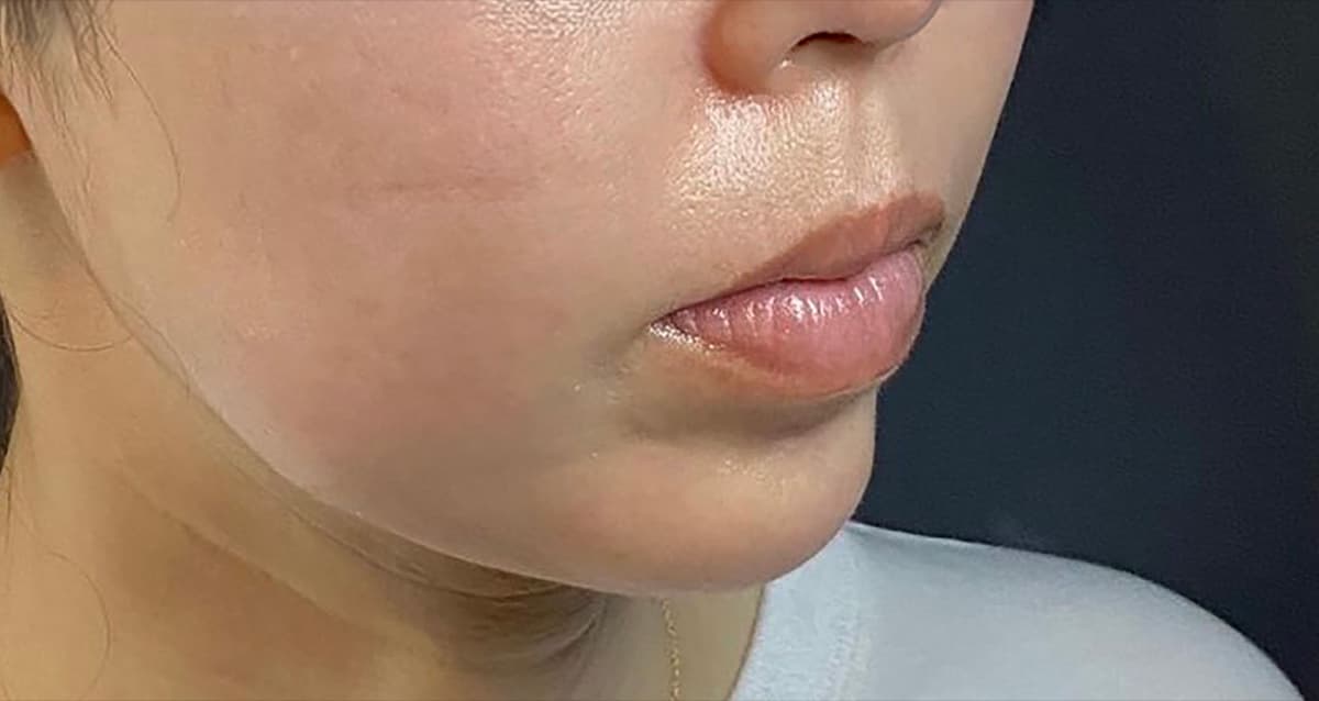 Chin Botox + Chin Filler After