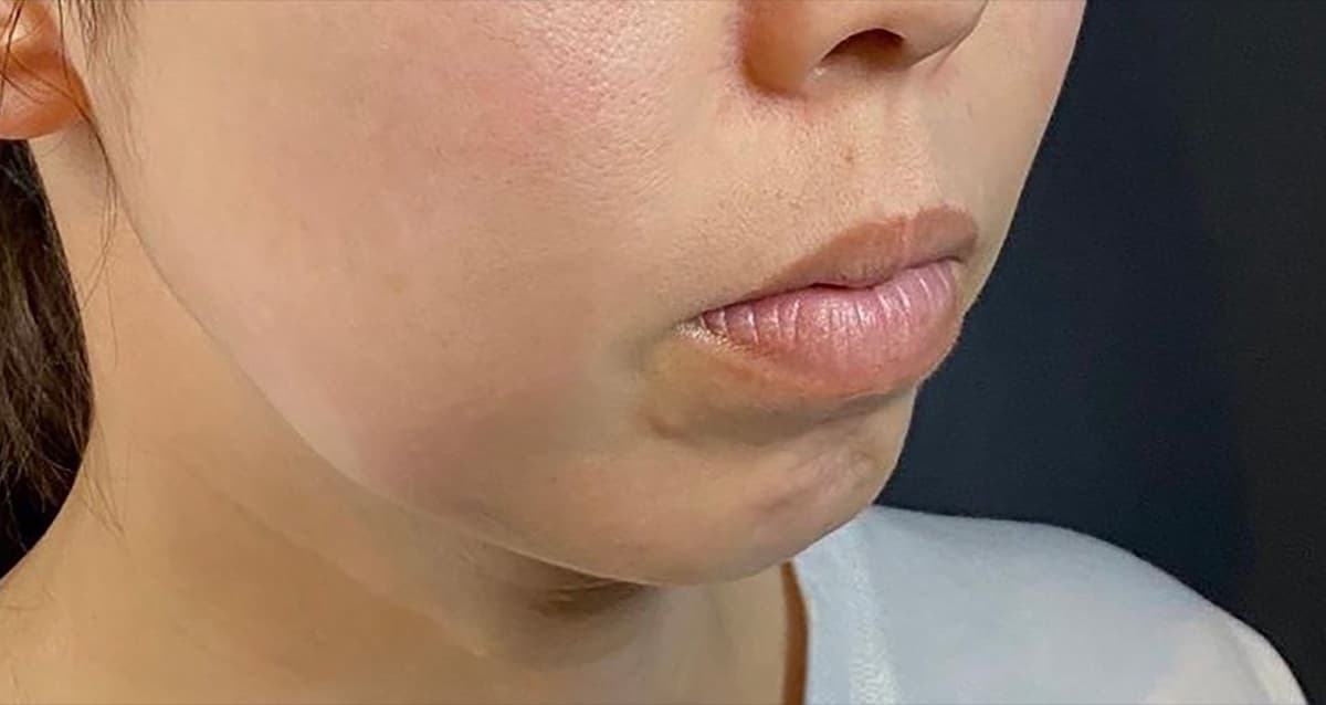 Chin Botox + Chin Filler Before