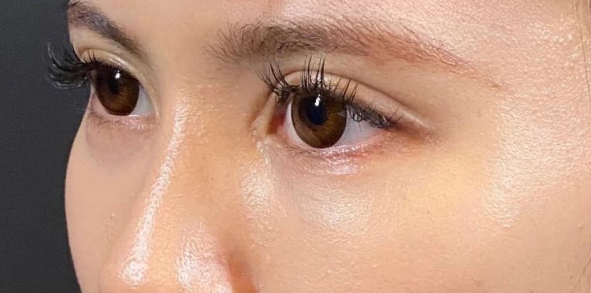 Lower Eyelid Fat Removal Surgery After