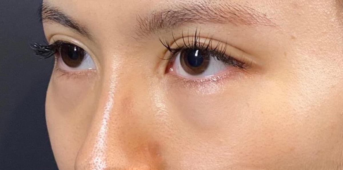 Lower Eyelid Fat Removal Surgery Before