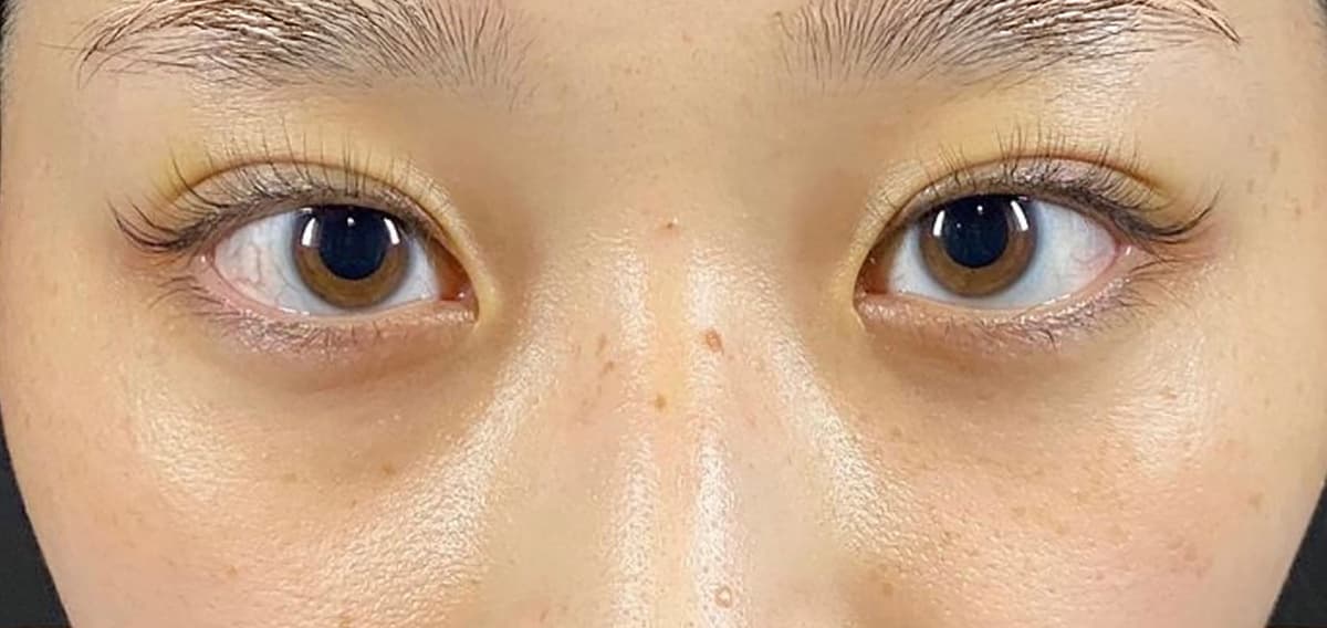 Rejuva Eyes Double (Eyelid) After