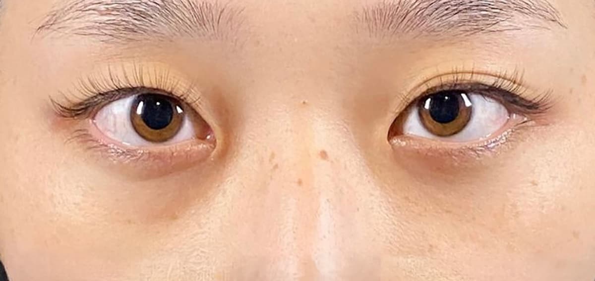 Rejuva Eyes Double (Eyelid) Before