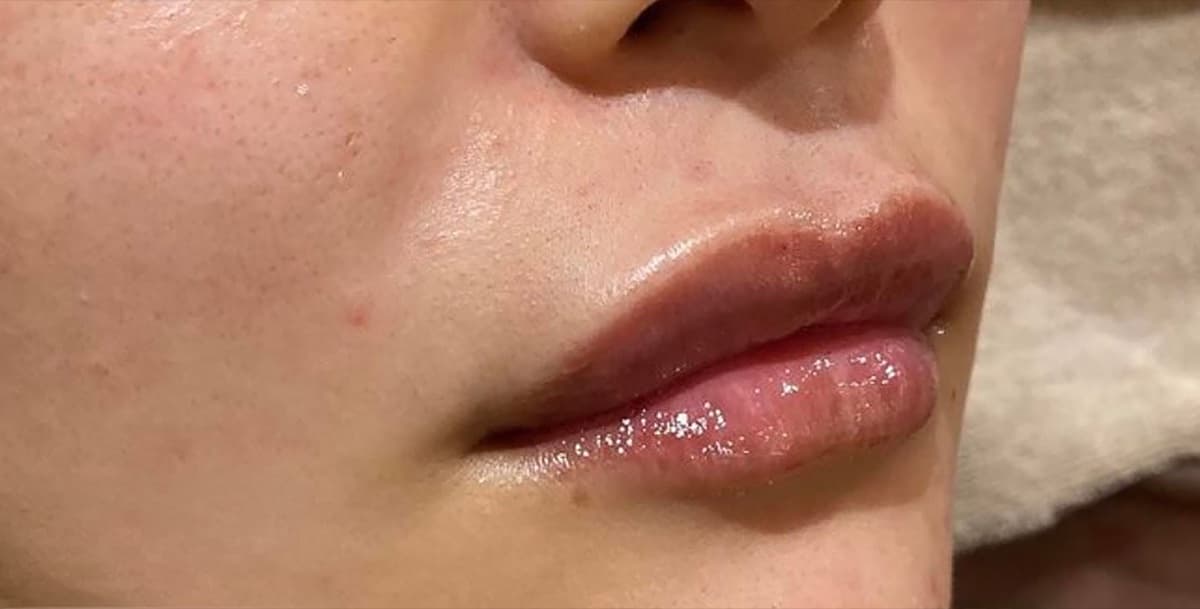 Philtrum Shortening (Botox + Filler) After