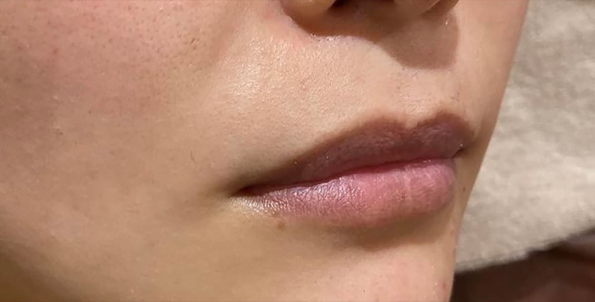 Philtrum Shortening (Botox + Filler) Before