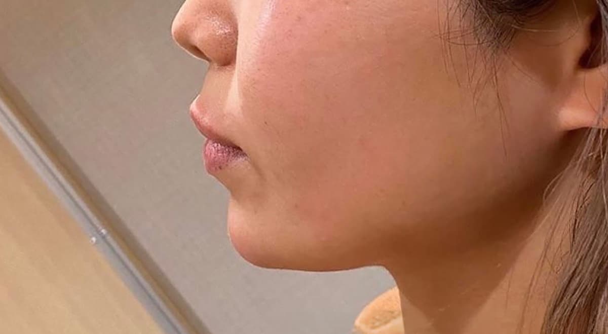 Chin Botox & Hyaluronic Acid Injection After