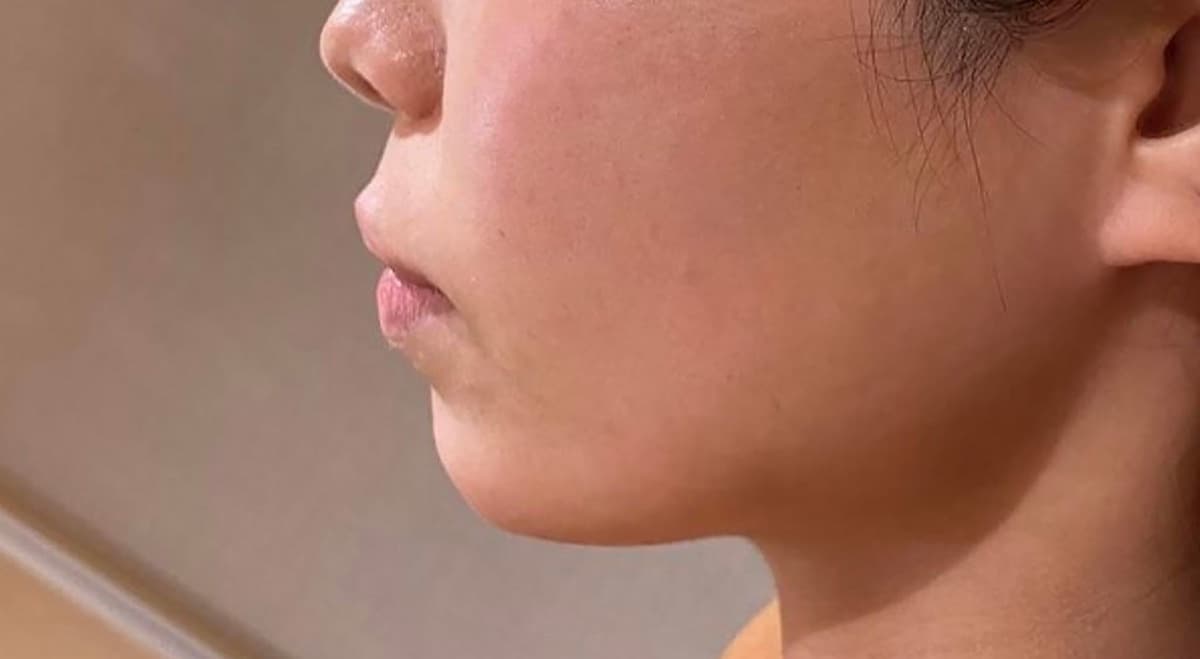 Chin Botox & Hyaluronic Acid Injection Before