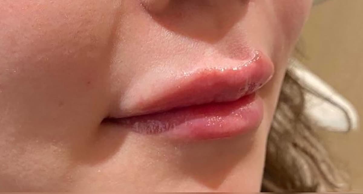 Philtrum Shortening (Botox + Filler) After
