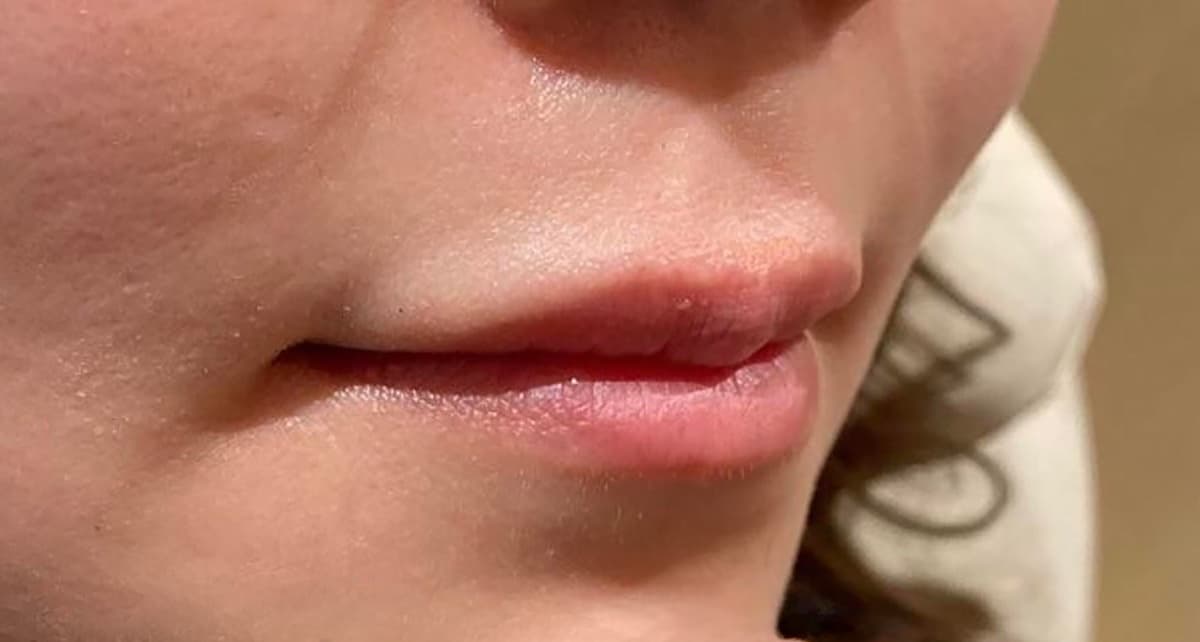 Philtrum Shortening (Botox + Filler) Before