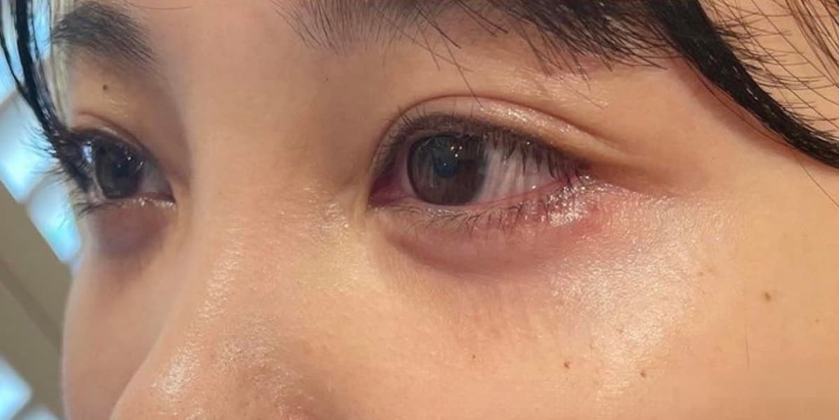 Tear Trough Hyaluronic Acid After