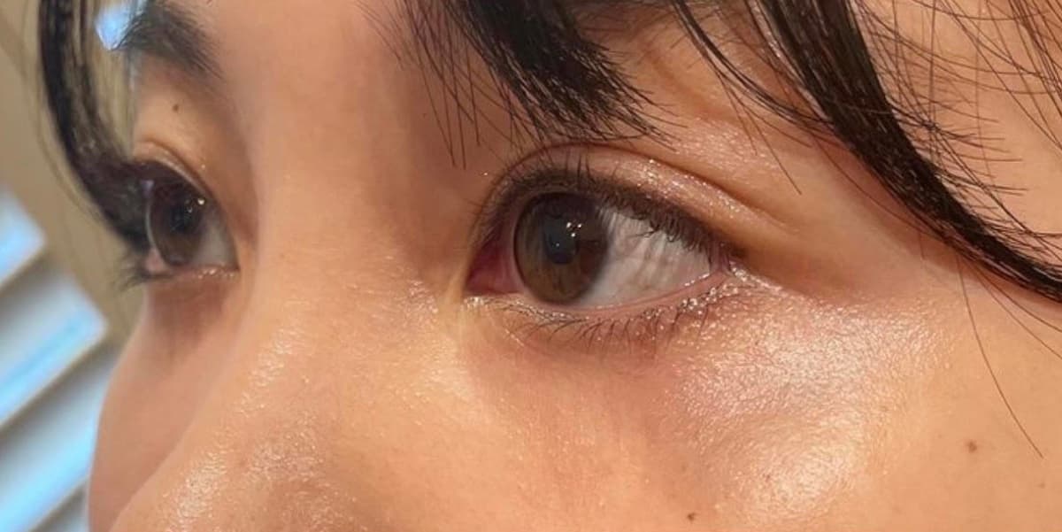 Tear Trough Hyaluronic Acid Before