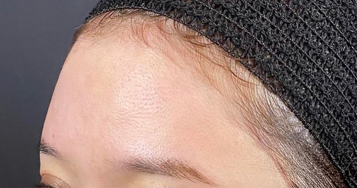 Forehead Hyaluronic Acid After