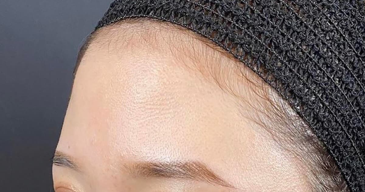 Forehead Hyaluronic Acid Before