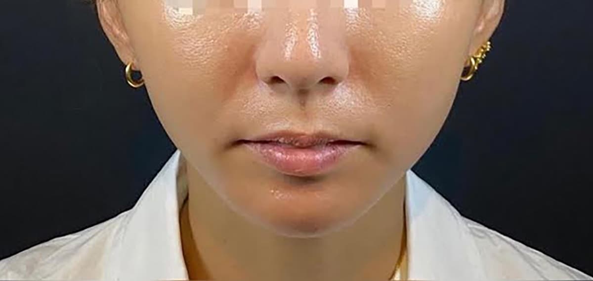Combination Lift (HIFU + Thread) After