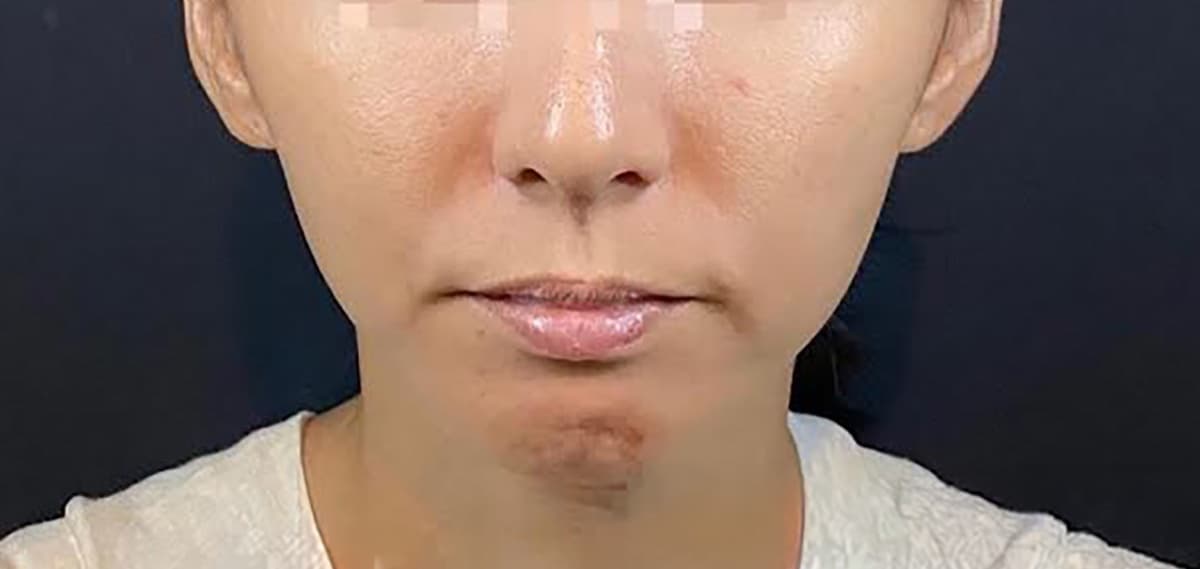 Combination Lift (HIFU + Thread) Before