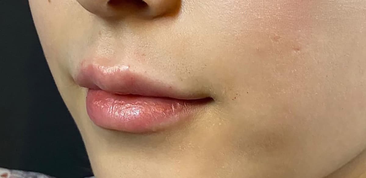 Philtrum Shortening Hyaluronic Acid Injection After