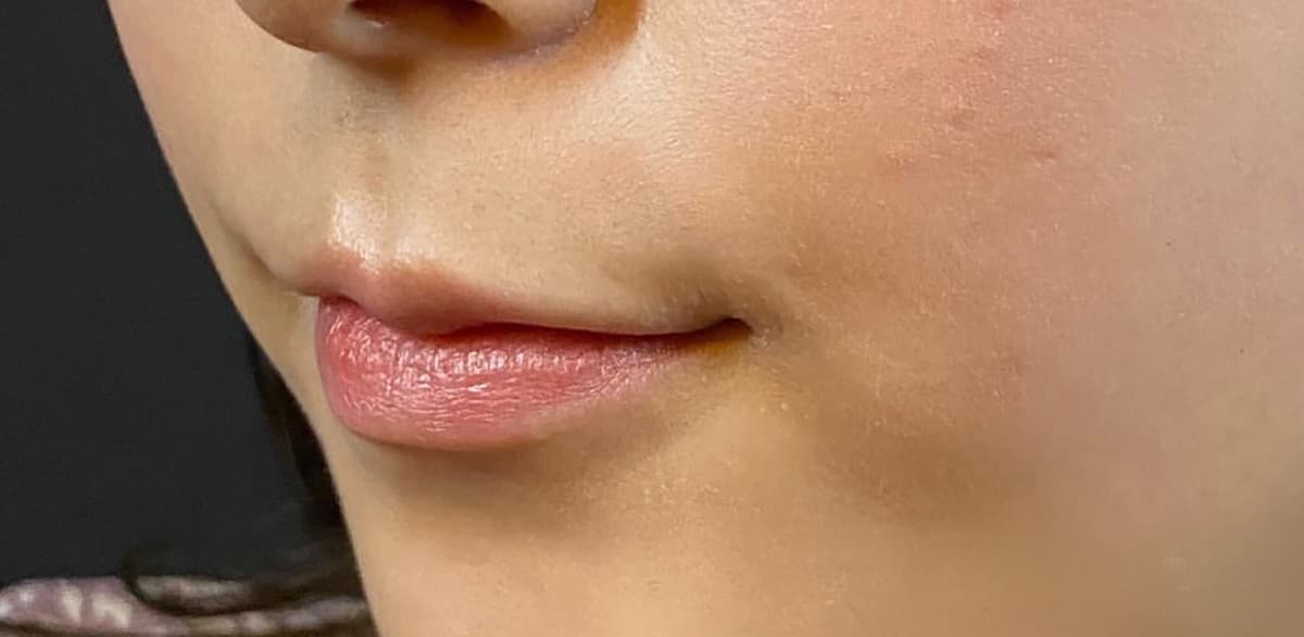 Philtrum Shortening Hyaluronic Acid Injection Before
