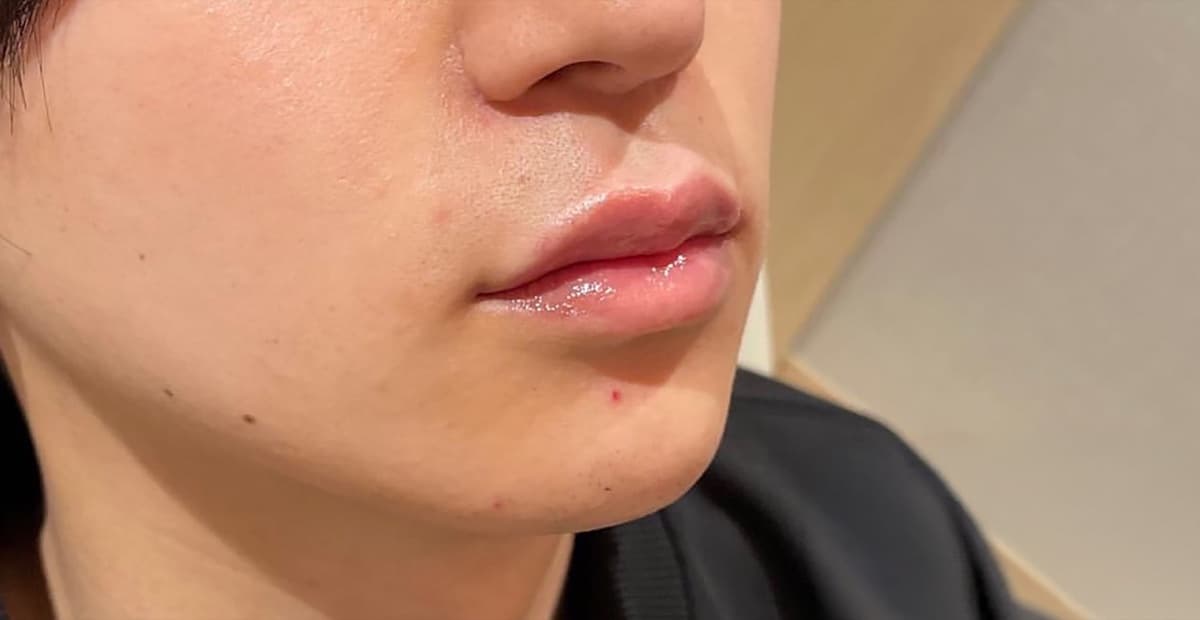 Lips & Chin Hyaluronic Acid Injection After