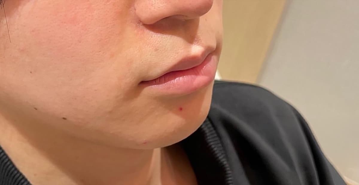 Lips & Chin Hyaluronic Acid Injection Before